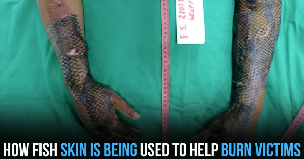 How Fish Skin is Being Used to Help Burn Victims