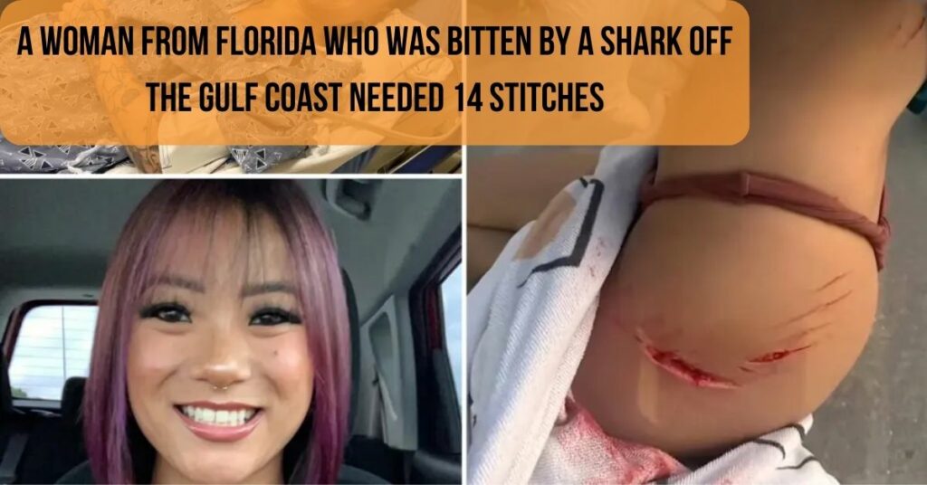A Woman From Florida Who Was Bitten By A Shark Off The Gulf Coast Needed 14 Stitches